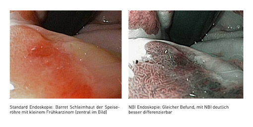 Prof. Dr. Horst Neuhaus: Krebsfrühstadien im Magen-Darm-Trakt: Endoskopische Therapie statt Operation